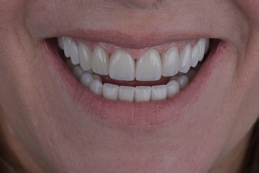Después — diseño de sonrisa