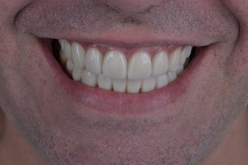 Después — diseño de sonrisa