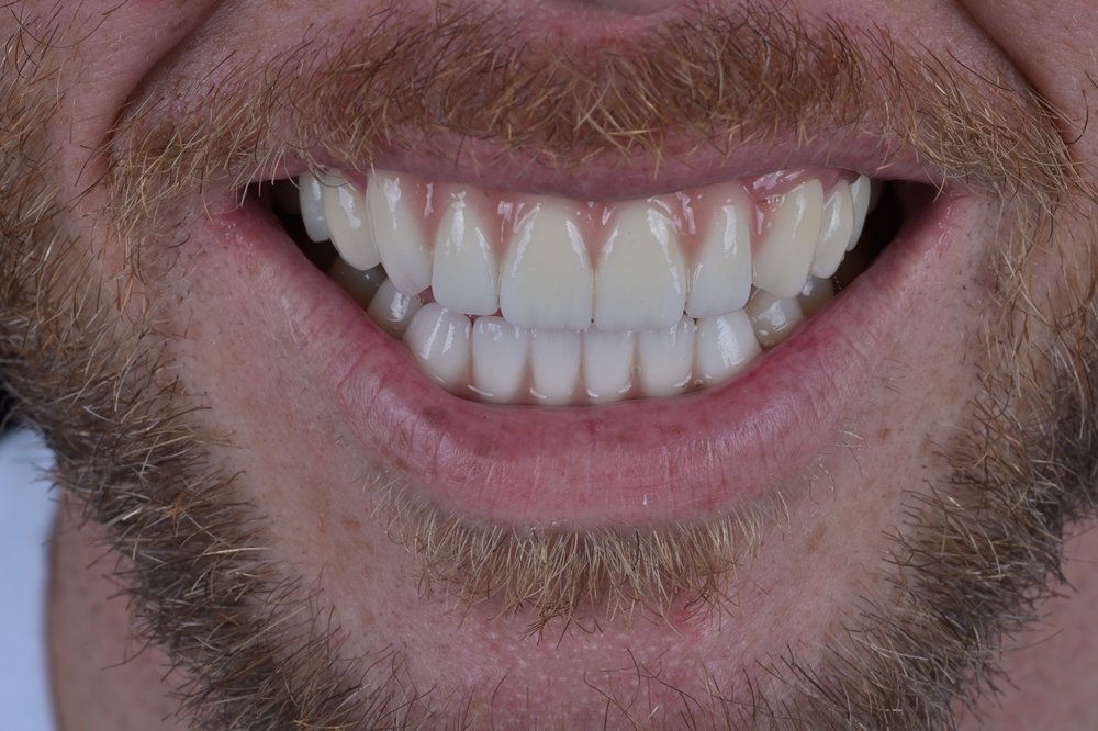 Después — diseño de sonrisa