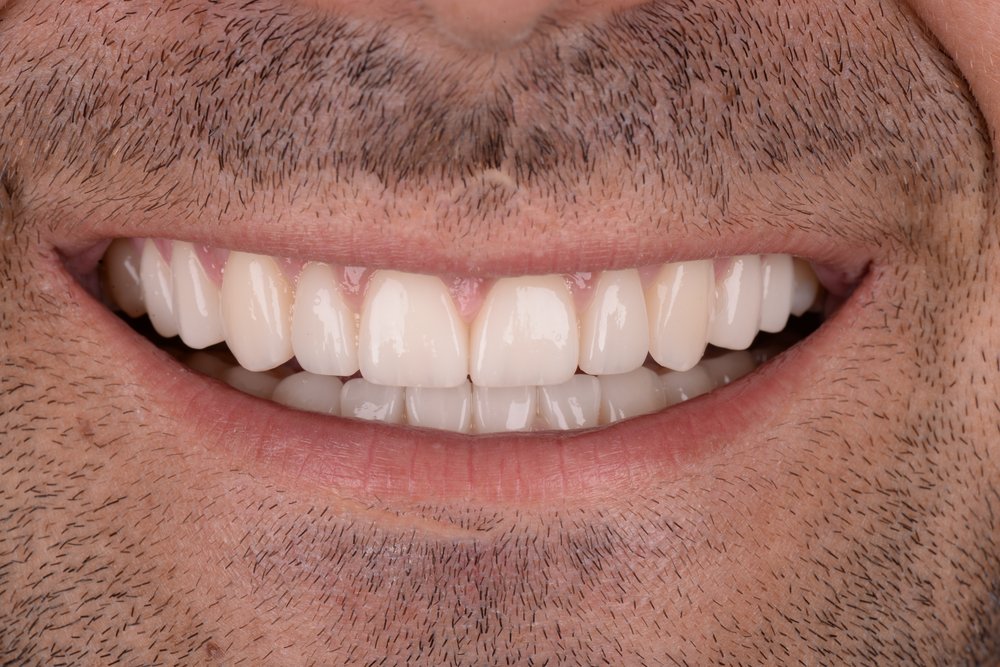 Después — diseño de sonrisa