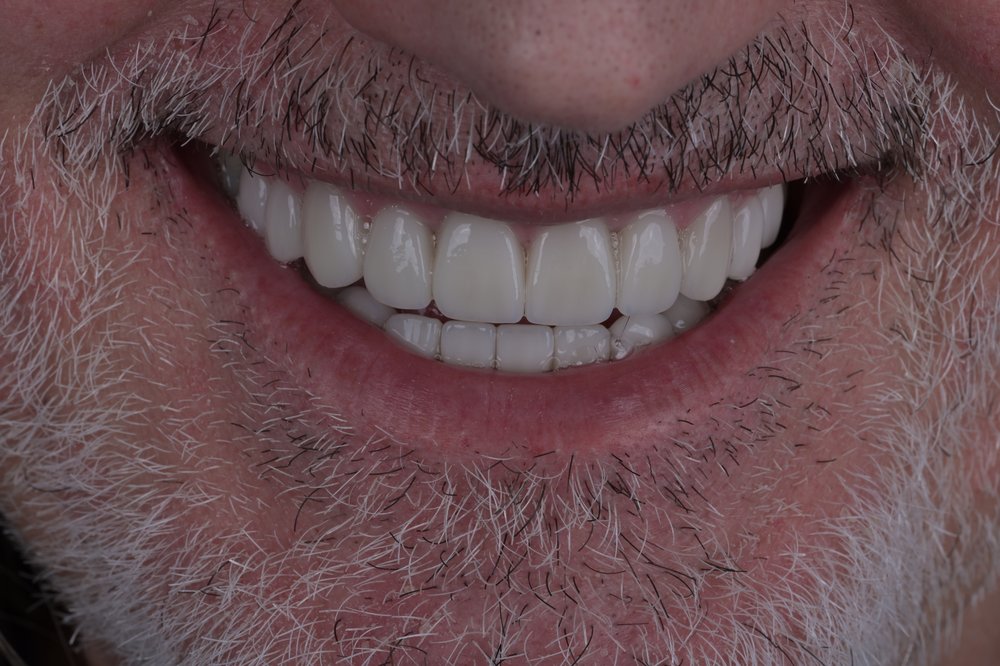 Después — diseño de sonrisa