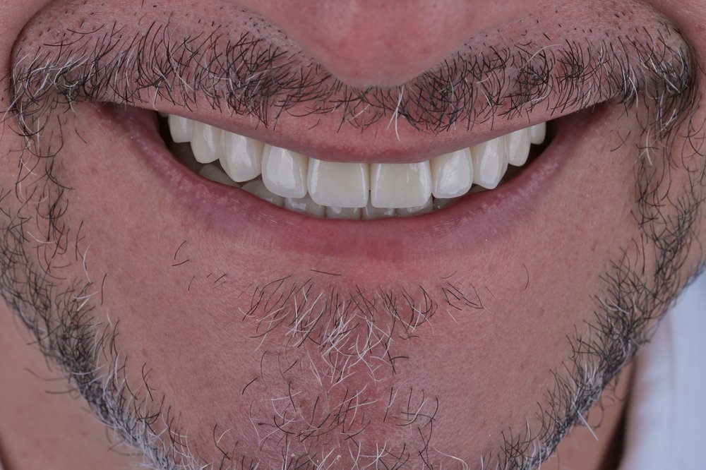 Después — diseño de sonrisa