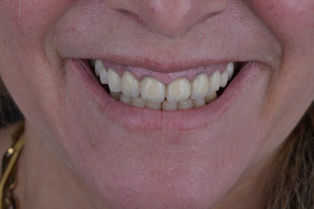 Antes — diseño de sonrisa