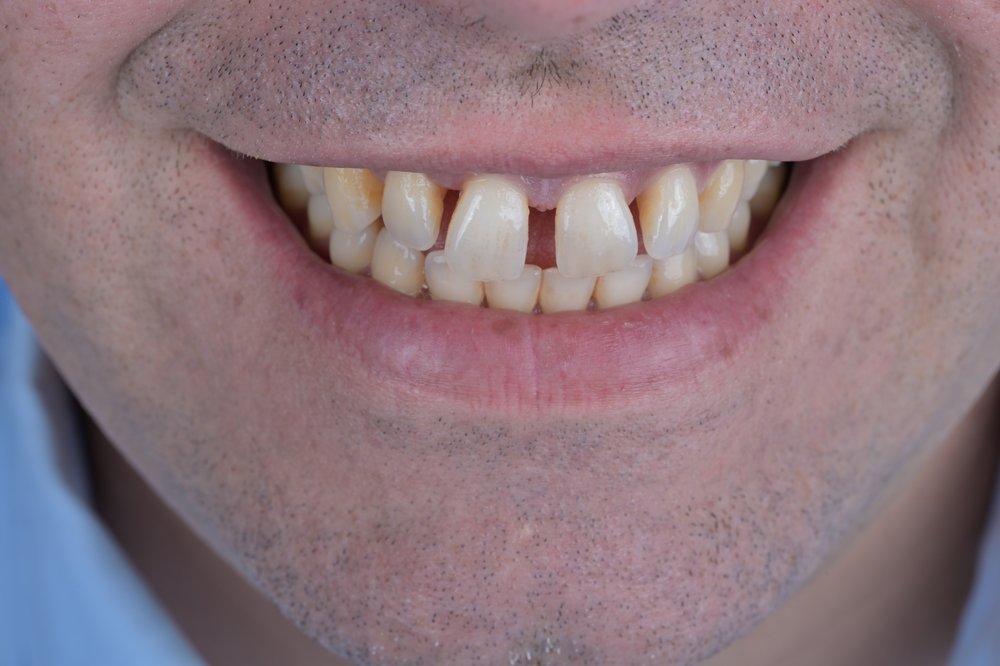 Antes — diseño de sonrisa