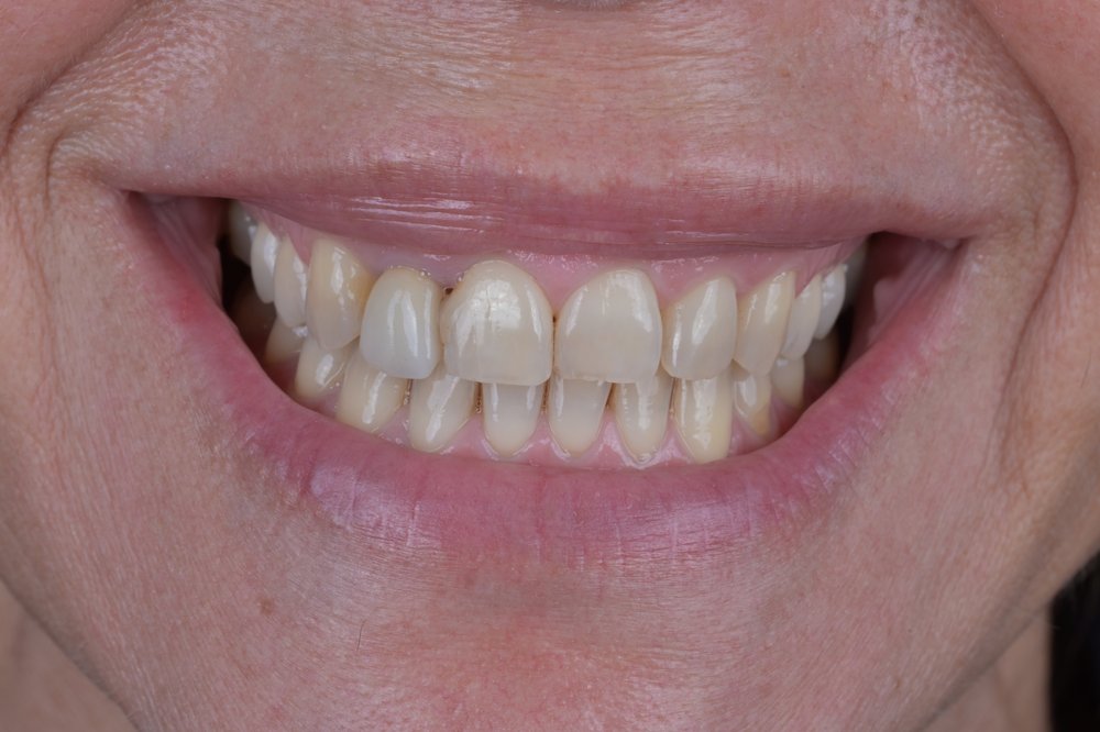 Antes — diseño de sonrisa