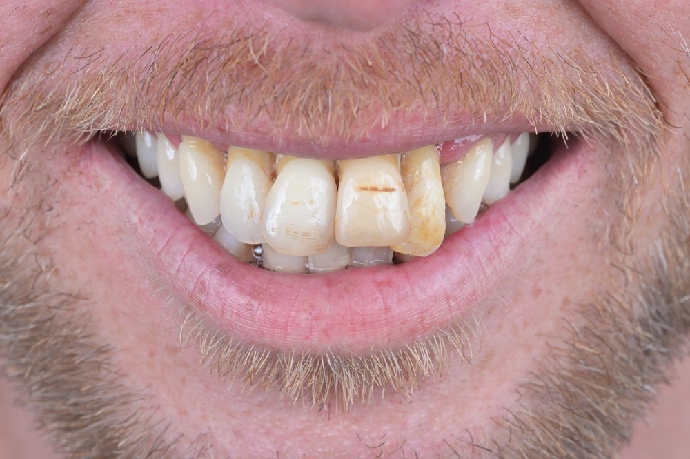 Antes — diseño de sonrisa