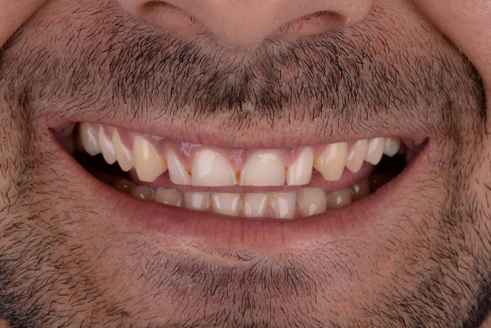 Antes — diseño de sonrisa