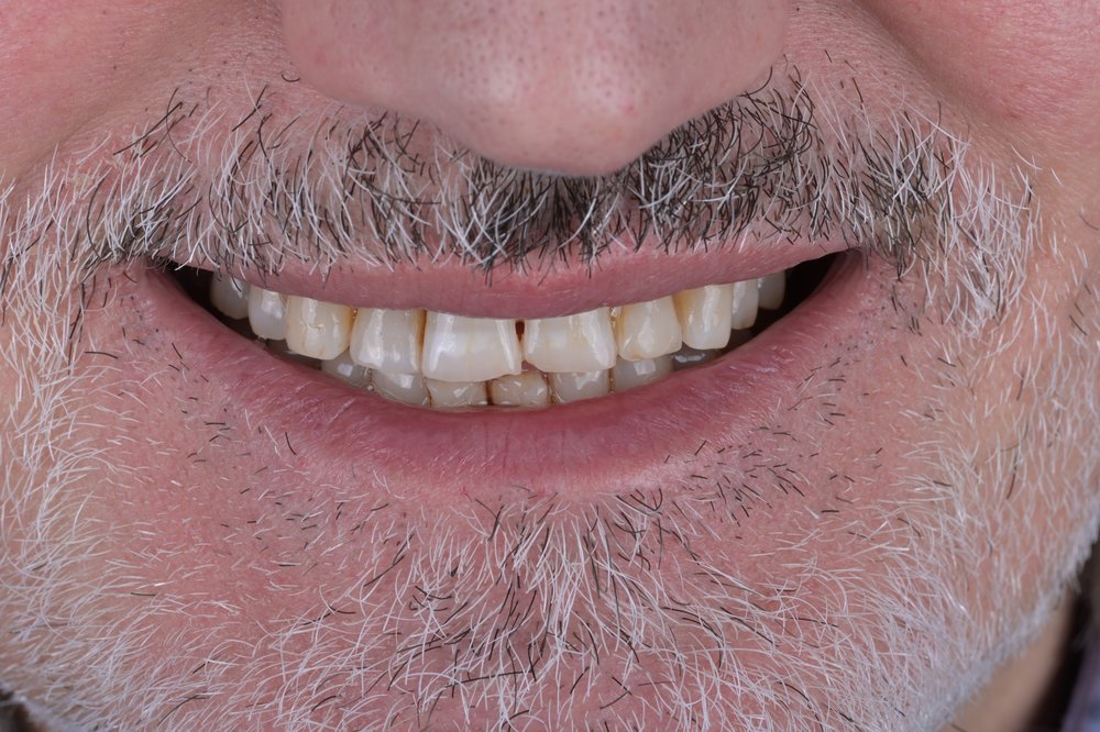 Antes — diseño de sonrisa