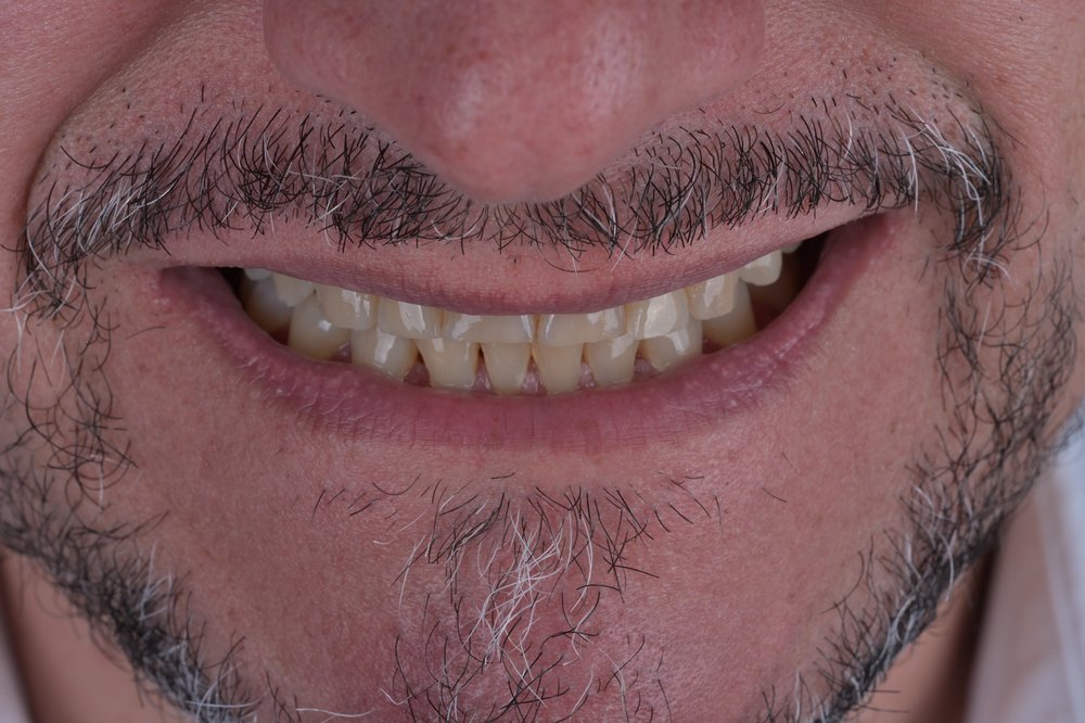 Antes — diseño de sonrisa