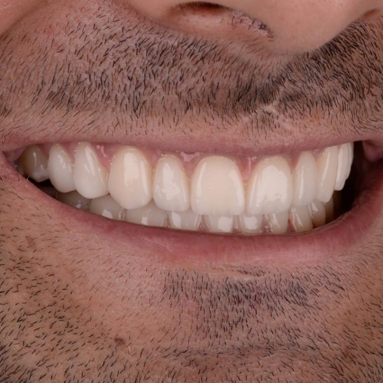 odontologia-casos-complejos-estetica-dental-barcelona