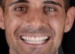 diseño-de-sonrisa-con-carillas-dentales