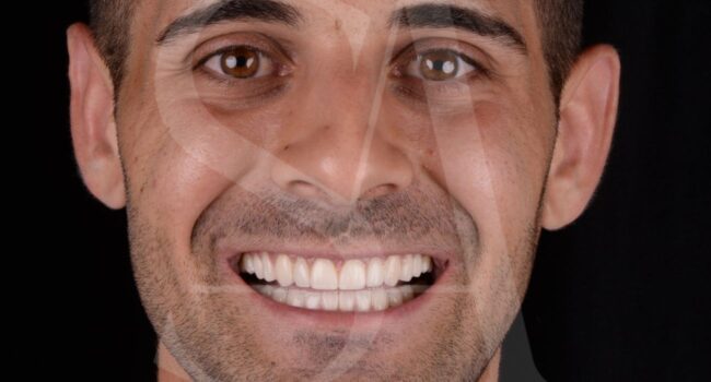 diseño-de-sonrisa-con-carillas-dentales diseño-de-sonrisa-con-carillas-dentales