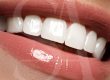 diseño-de-sonrisas-barcelona-carillas-dentales