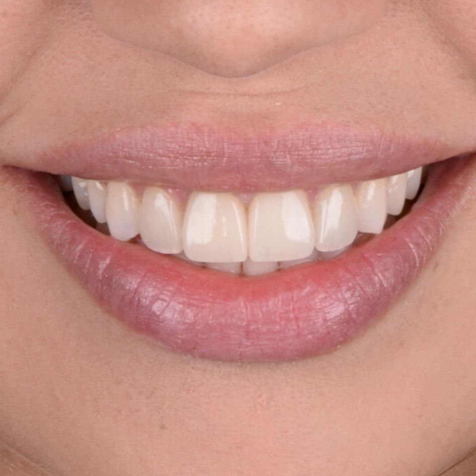 carillas-dentales-estetica-dental-barcelona-lp