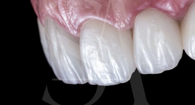 carillas-porcelana-barcelona-ventajas-desventajas carillas-porcelana-barcelona-ventajas-desventajas