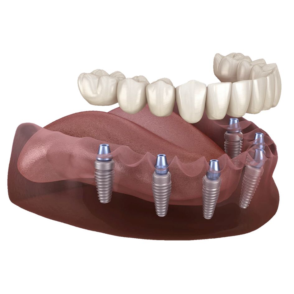 implantes-carga-inmediata-barcelona-Sergi-Arranz