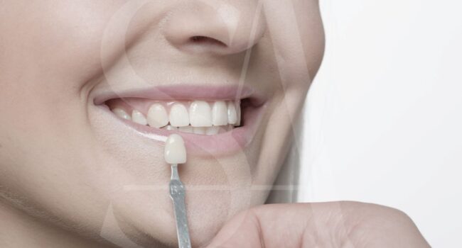 mock-up-dental-estetica-barcelona mock-up-dental-estetica-barcelona