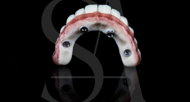 implantes-all-on-four-barcelona implantes-all-on-four-barcelona