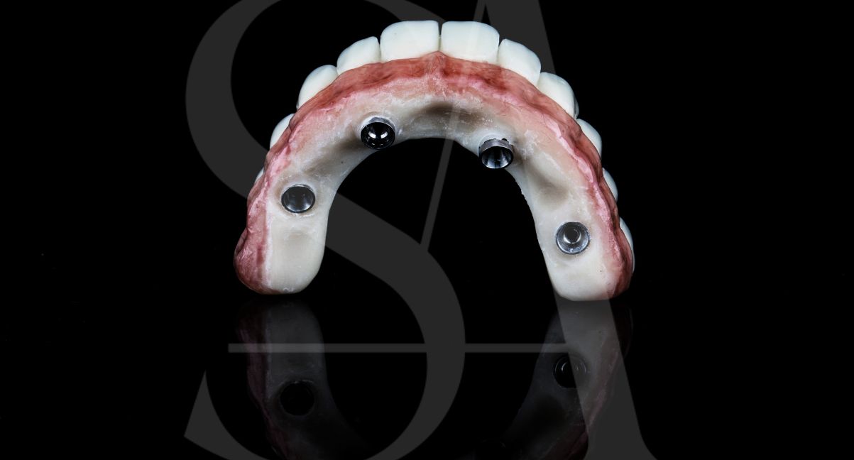 implantes-all-on-four-barcelona