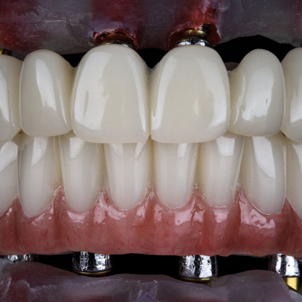 implantes-y-protesis-dentales-all-on-four