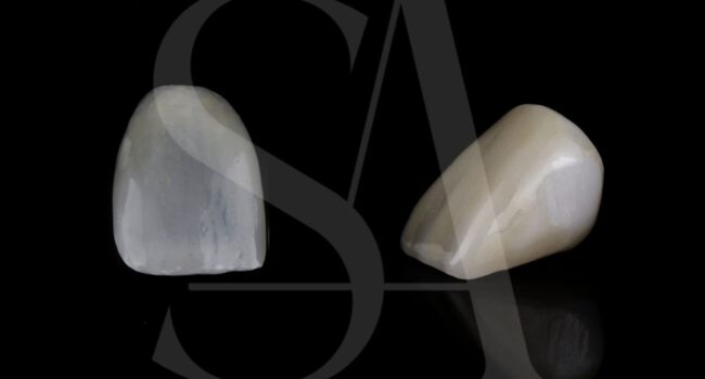 carillas-dentales-o-coronas-dentales carillas-dentales-o-coronas-dentales