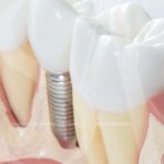 implantes-dentales-poco-hueso