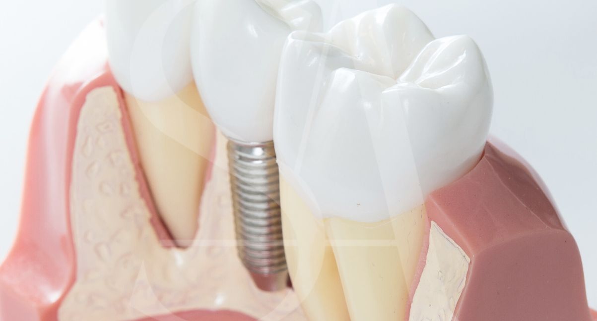 implantes-dentales-poco-hueso