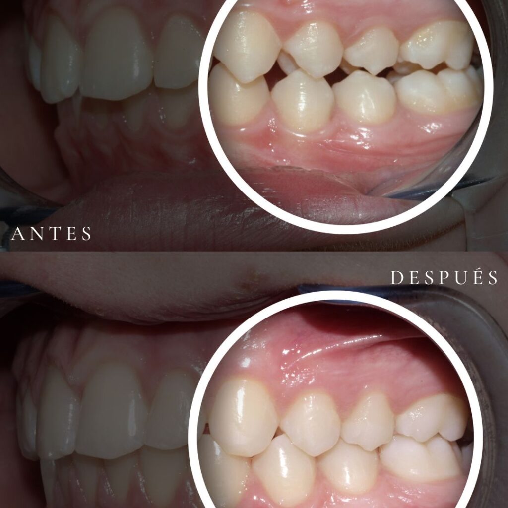 maloclusion-caso-antes-despues