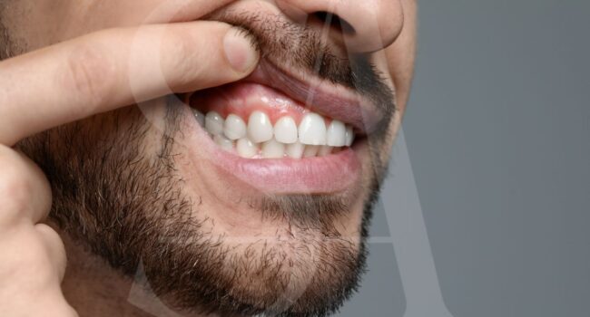 periodontitis-solucion-carillas-dentales periodontitis-solucion-carillas-dentales
