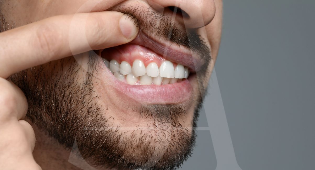 periodontitis-solucion-carillas-dentales