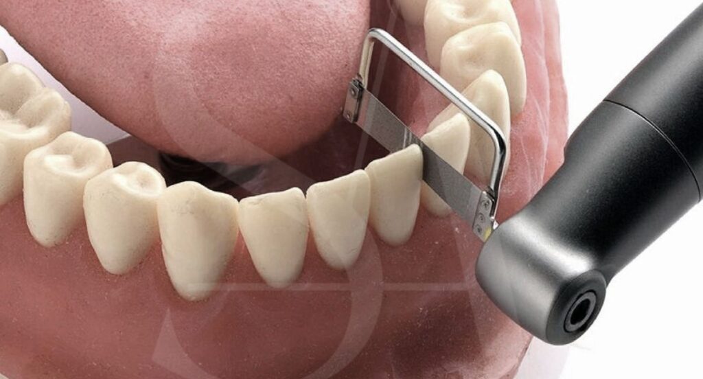 stripping-dental-ortodoncia