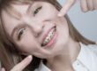 stripping-dental-ortodoncia-en-barcelona